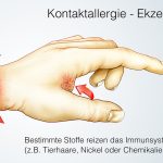 Erklärung welche Stoffe eine Kontaktallergie auslösen können