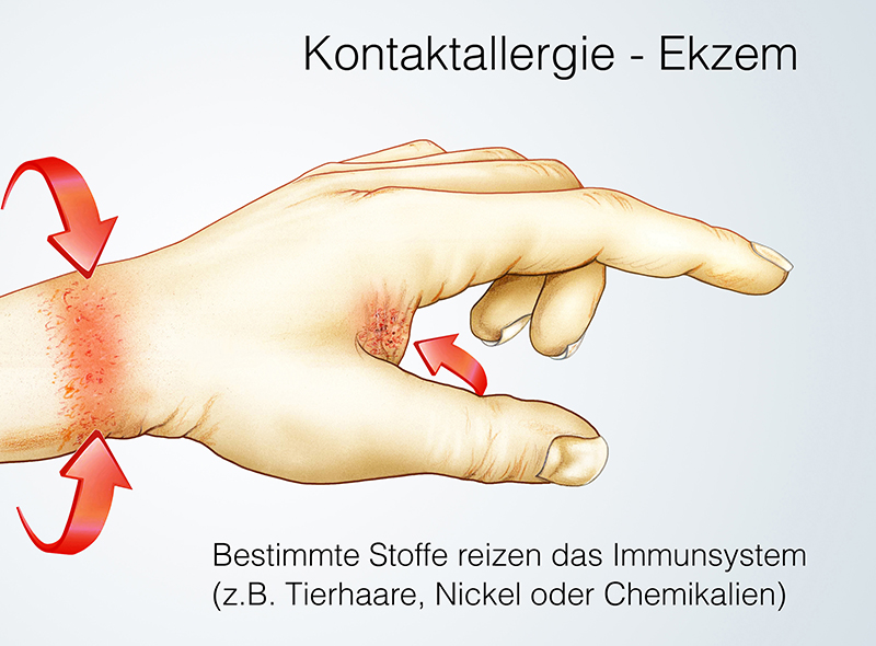 Kontaktallergie.Ekzem Erklärung welche Stoffe eine Kontaktallergie auslösen können