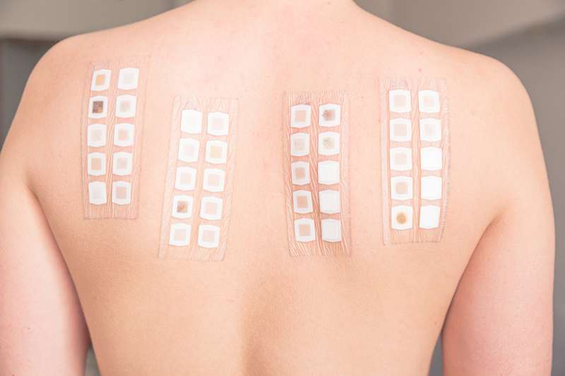 Alergy patch test on the back of a young woman Frau mit eine Patch-Test auf dem Rücken.