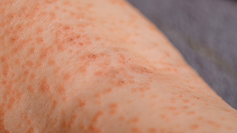 Porphyrie erkennen: Warum die Diagnose oft spät gestellt wird